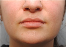 Lip Augmentation/Enhancement Before Photo by Ellen Mahony, MD; Westport, CT - Case 44561