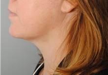 Liposuction After Photo by Ellen Mahony, MD; Westport, CT - Case 44566