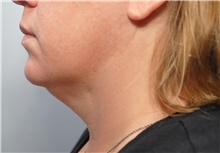 Liposuction Before Photo by Ellen Mahony, MD; Westport, CT - Case 44566