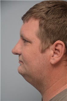 Rhinoplasty After Photo by Carlos Rivera-Serrano, MD; ,  - Case 44610