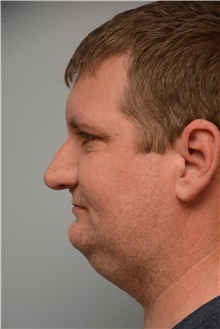 Rhinoplasty Before Photo by Carlos Rivera-Serrano, MD; ,  - Case 44610