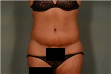 Tummy Tuck After Photo by Ellen Janetzke, MD; Bloomfield Hills, MI - Case 44649