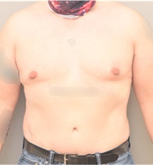 Tummy Tuck After Photo by Keshav Magge, MD; Bethesda, MD - Case 44807