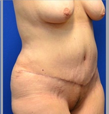 Tummy Tuck After Photo by Stanley Okoro, MD; ,  - Case 44841