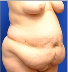 Tummy Tuck Before Photo by Stanley Okoro, MD; ,  - Case 44841