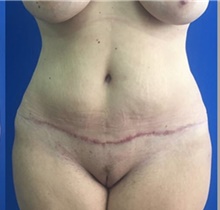 Tummy Tuck After Photo by Stanley Okoro, MD; ,  - Case 44854