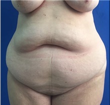 Tummy Tuck Before Photo by Stanley Okoro, MD; ,  - Case 44854