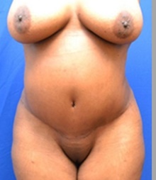 Tummy Tuck After Photo by Stanley Okoro, MD; ,  - Case 44857