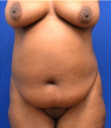 Tummy Tuck Before Photo by Stanley Okoro, MD; ,  - Case 44857