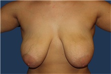 Breast Lift Before Photo by Barry Douglas, MD, FACS; ,  - Case 44870