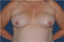 Breast Reconstruction Before Photo by Jerry Weiger Chang, MD, FACS; Flushing, NY - Case 44896