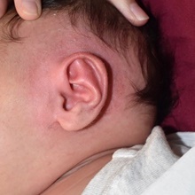 Ear Surgery After Photo by Rachel Ruotolo, MD; Garden City, NY - Case 44941