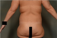 Body Lift After Photo by Ellen Janetzke, MD; Bloomfield Hills, MI - Case 45203