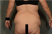 Body Lift Before Photo by Ellen Janetzke, MD; Bloomfield Hills, MI - Case 45203
