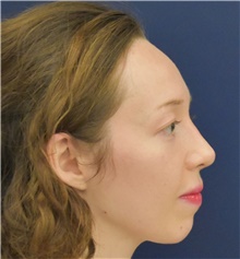 Rhinoplasty After Photo by Richard Reish, MD, FACS; New York, NY - Case 45294