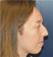 Rhinoplasty Before Photo by Richard Reish, MD, FACS; New York, NY - Case 45294