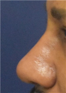 Rhinoplasty After Photo by Richard Reish, MD, FACS; New York, NY - Case 45319