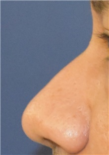 Rhinoplasty Before Photo by Richard Reish, MD, FACS; New York, NY - Case 45319