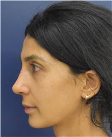 Rhinoplasty After Photo by Richard Reish, MD, FACS; New York, NY - Case 45356