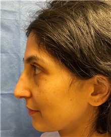 Rhinoplasty Before Photo by Richard Reish, MD, FACS; New York, NY - Case 45356