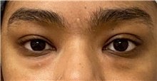 Eyelid Surgery Before Photo by Keshav Magge, MD; Bethesda, MD - Case 45618