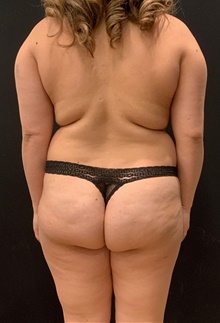 Buttock Lift with Augmentation Before Photo by Johnny Franco, MD; ,  - Case 45811