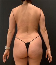 Buttock Lift with Augmentation Before Photo by Johnny Franco, MD; ,  - Case 45812