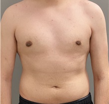 Male Breast Reduction After Photo by Keshav Magge, MD; Bethesda, MD - Case 45825