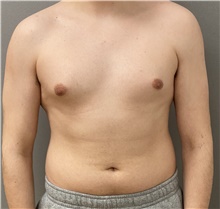 Male Breast Reduction Before Photo by Keshav Magge, MD; Bethesda, MD - Case 45825