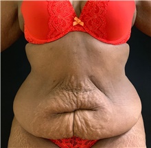 Tummy Tuck Before Photo by Russell Babbitt, MD; Fall River, MA - Case 45932