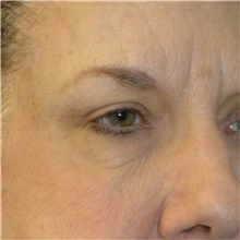 Brow Lift After Photo by Scott Sattler, MD,  FACS; Seattle, WA - Case 46056