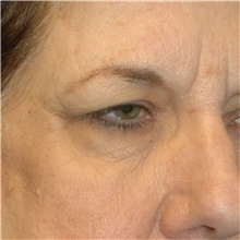 Brow Lift Before Photo by Scott Sattler, MD,  FACS; Seattle, WA - Case 46056