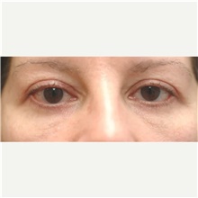 Eyelid Surgery After Photo by Franklin Richards, MD; ,  - Case 46119