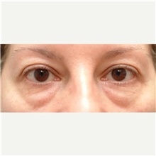 Eyelid Surgery Before Photo by Franklin Richards, MD; ,  - Case 46119