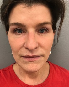 Facelift After Photo by Franklin Richards, MD; ,  - Case 46141