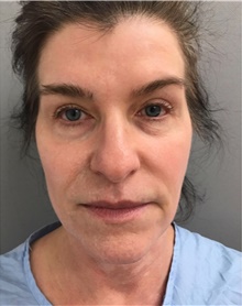 Facelift Before Photo by Franklin Richards, MD; ,  - Case 46141