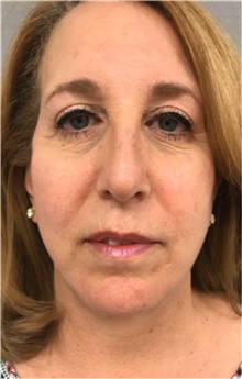 Facelift After Photo by Franklin Richards, MD; ,  - Case 46142