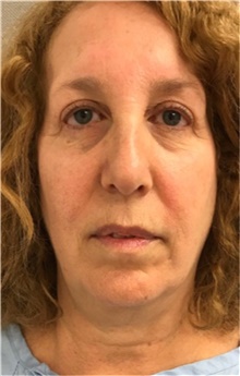 Facelift Before Photo by Franklin Richards, MD; ,  - Case 46142