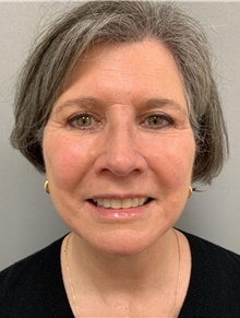 Facelift After Photo by Franklin Richards, MD; ,  - Case 46145