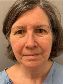 Facelift Before Photo by Franklin Richards, MD; ,  - Case 46145
