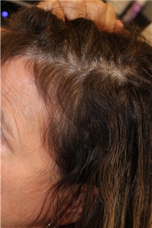 Hair Transplant After Photo by Ellen Mahony, MD; Westport, CT - Case 46406