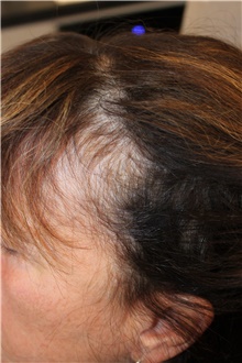 Hair Transplant Before Photo by Ellen Mahony, MD; Westport, CT - Case 46406
