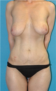 Mommy Makeover Before Photo by Scott Sattler, MD,  FACS; Seattle, WA - Case 46525