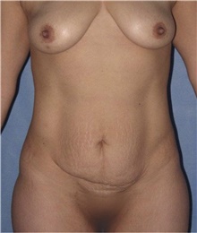 Mommy Makeover Before Photo by Keyian Paydar, MD, FACS; Newport Beach, CA - Case 46887