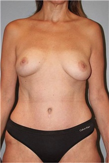 Mommy Makeover After Photo by Keyian Paydar, MD, FACS; Newport Beach, CA - Case 46904