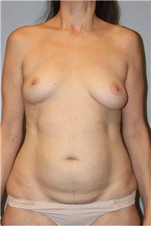 Mommy Makeover Before Photo by Keyian Paydar, MD, FACS; Newport Beach, CA - Case 46904