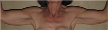 Arm Lift Before Photo by Keyian Paydar, MD, FACS; Newport Beach, CA - Case 46965