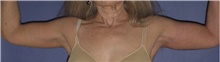Arm Lift After Photo by Keyian Paydar, MD, FACS; Newport Beach, CA - Case 46984