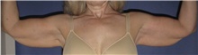 Arm Lift Before Photo by Keyian Paydar, MD, FACS; Newport Beach, CA - Case 46984