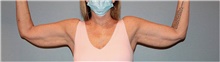 Arm Lift Before Photo by Keyian Paydar, MD, FACS; Newport Beach, CA - Case 46985